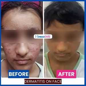 Dermatitis on Face Transformation: Before - evident skin issues. After - noticeable improvement, thanks to Homeopathic Treatment for Dermatitis